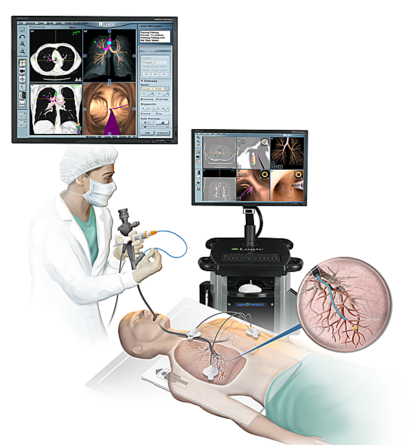 LewisGale Offers New Procedure  for Detecting Early-Stage Lung Cancer