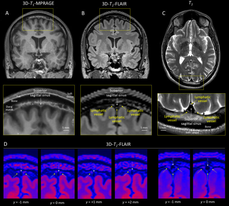 UVA Concussion Discovery Reveals Dire, Unknown Effect of Even Mild Brain Injuries